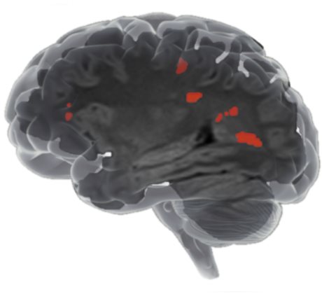 Icometrix brain MRI lesions_web